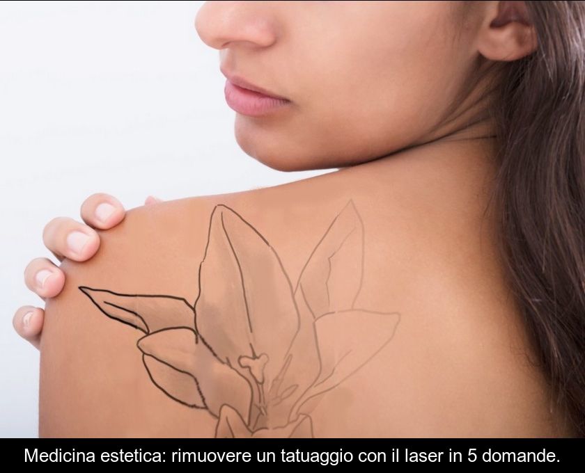 Medicina Estetica: Rimuovere Un Tatuaggio Con Il Laser In 5 Domande.