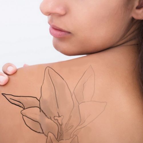 Medicina estetica: rimuovere un tatuaggio con il laser in 5 domande.