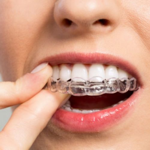 Ortodonzia per adulti: 7 cose da sapere sulle mascherine dentali invisibili